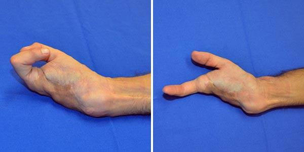 Arteriovenous malformation of the hand