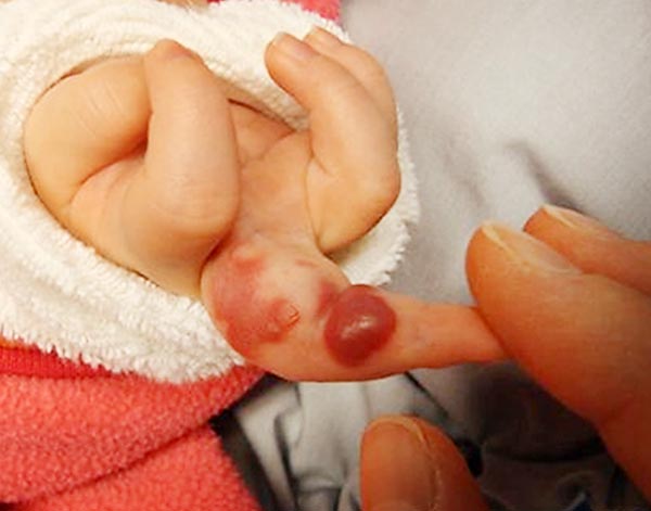 girl with a progressive, red, pulsatile tumor on the left middle finger