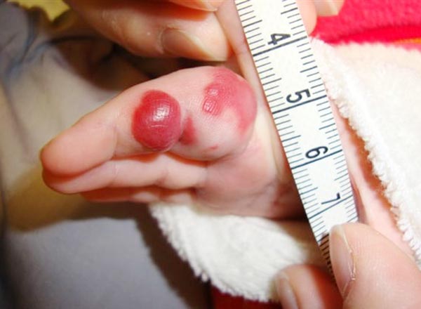 girl with a progressive, red, pulsatile tumor on the left middle finger