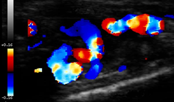 Color-coded duplex ultrasonography: massive increased blood flow