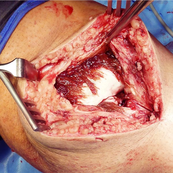 Intraoperative: opening of the knee joint