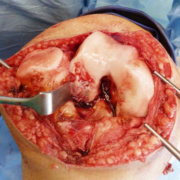 Intraoperative: removal of the synovium and venous malformation