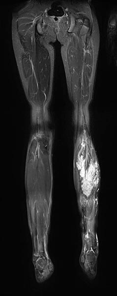 MRI: FAVA in the calf