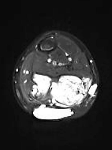 MRI: FAVA in the calf