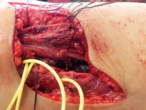 Intraoperative: FAVA in the calf