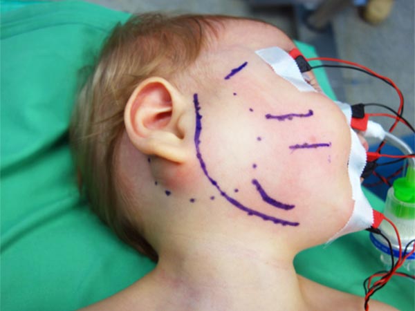 Intraoperative: lymphatic malformation of the parotid gland