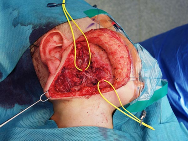 Intraoperative: lymphatic malformation of the parotid gland