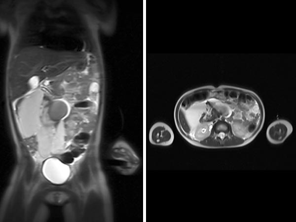 MRI: extensive macrocystic lymphatic malformation