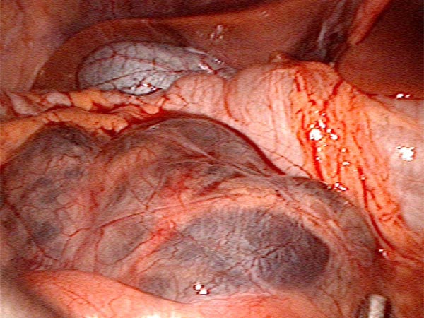 Cysts of the lymphatic malformation