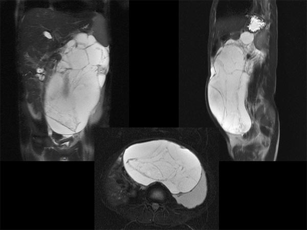 MRI: giant cysts due to a macrocystic lymphatic malformation