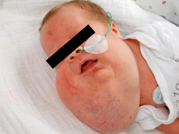 Lymphatic malformation of the face