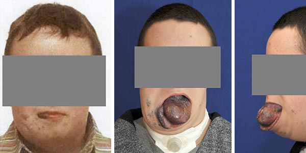 Venous malformation (VM) - tongue, pharynx, cheek, lower lip on right side