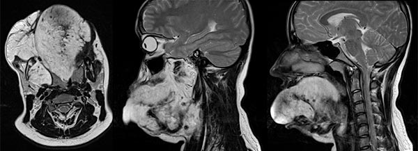 MRI: extensive venous malformation