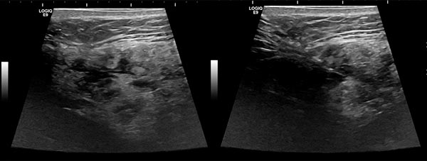 Sonography: before sclerotherapy