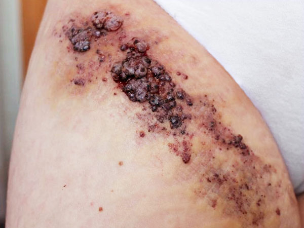 Lymphatic malformation with lymphorrhea