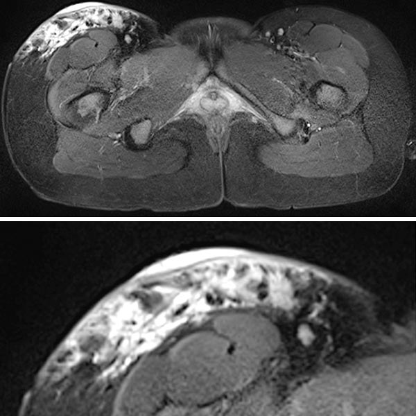 MRI: purely epifascial extension of the lymphatic malformation
