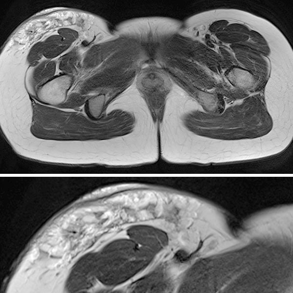 MRI: connective tissue parts of the lymphatic malformation