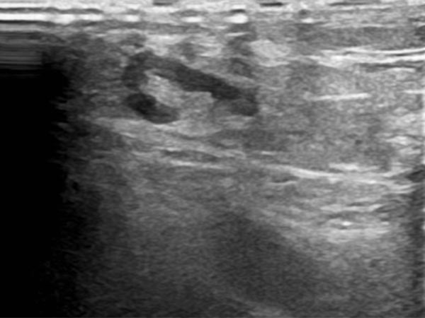 Sonography: dysplastic dilated lymphatic duct