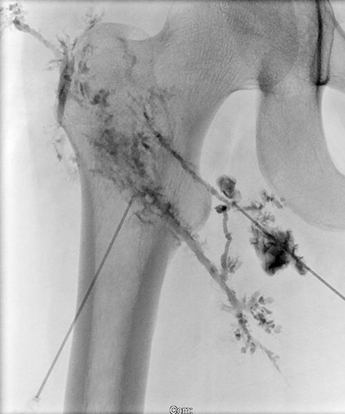 Lymphography: dysplastic dilation