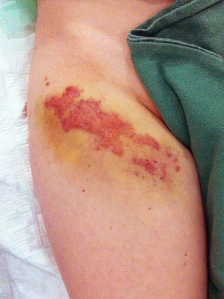 Sclerotherapy and laser treatment