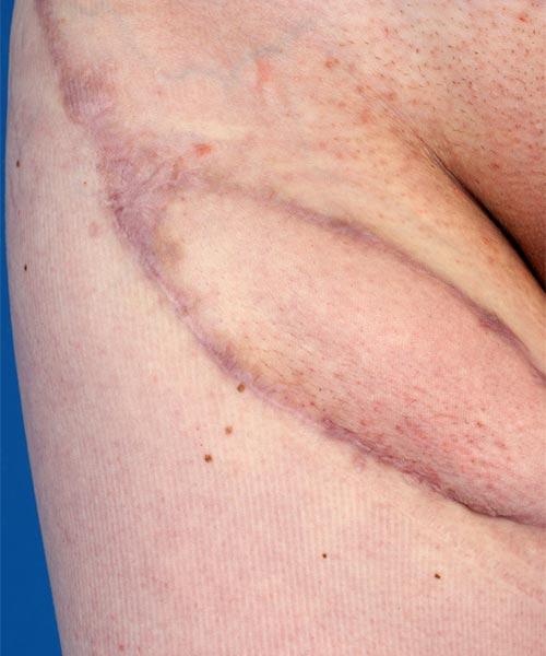 Lymphatic malformation after combination therapy