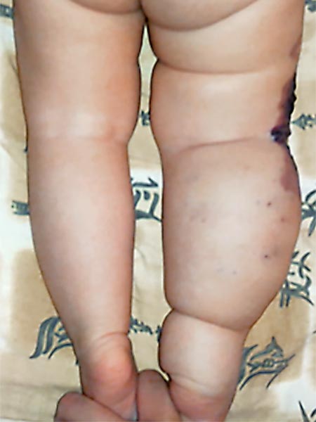 Klippel-Trénaunay syndrome from the dorsal view