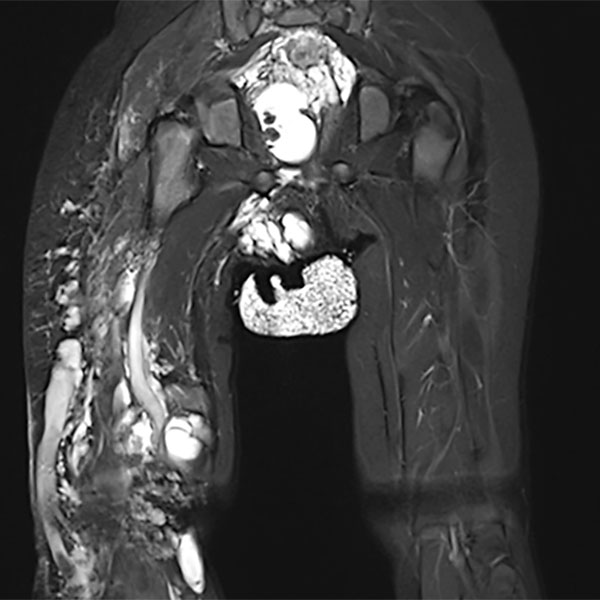 Microcystic and macrocystic lymphatic malformation components