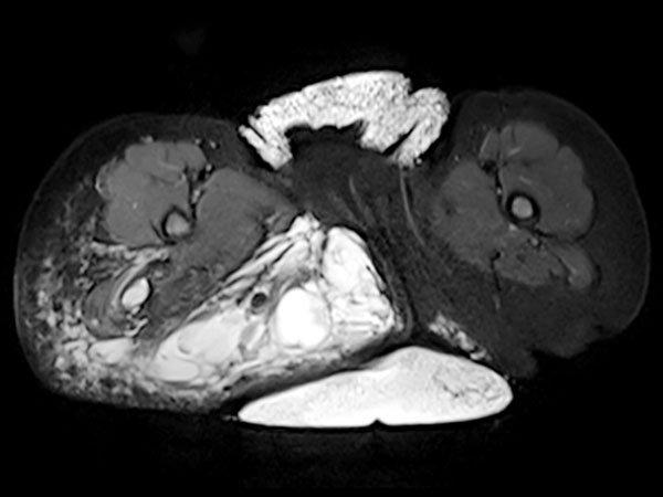 MRI: massive extension especially of the lymphatic malformation