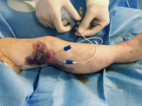Sclerotherapy: to puncture the lymphatic malformation