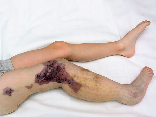 Lymphedema remains mild