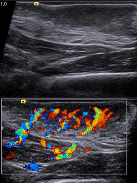 Sonography: tumor