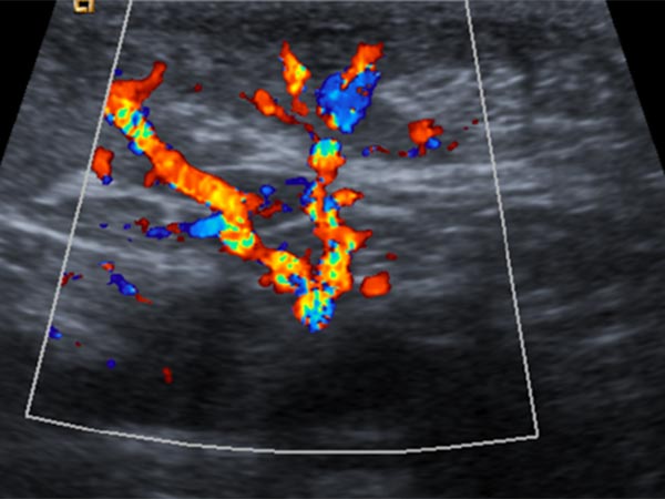 Sonography: continued strong perfusion