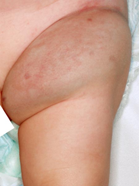 https://www.compva.com/fileadmin/images/patientenbeispiele/29-nich-leiste/f29-04-non-involuting-congenital-hemangioma-leiste.jpg