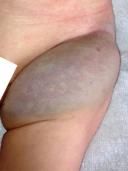 https://www.compva.com/fileadmin/images/patientenbeispiele/29-nich-leiste/f29-05-non-involuting-congenital-hemangioma-leiste.jpg