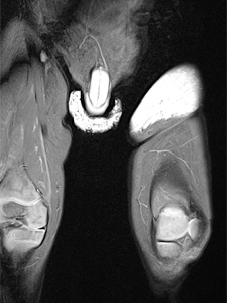 MRI: tumor in the left groin