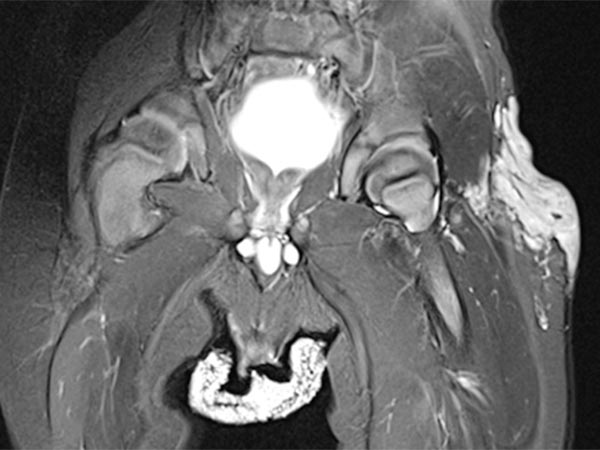 MRI: tumor in the left groin