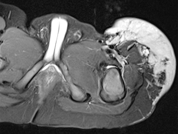 MRI: tumor in the left groin