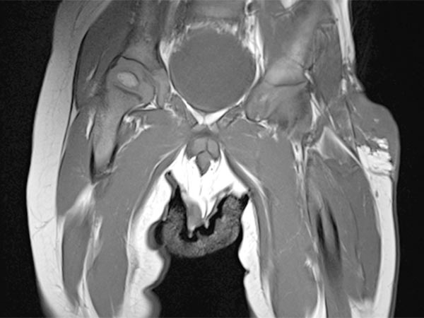 MRI: tumor in the left groin