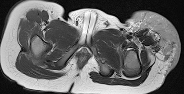MRI: tumor in the left groin