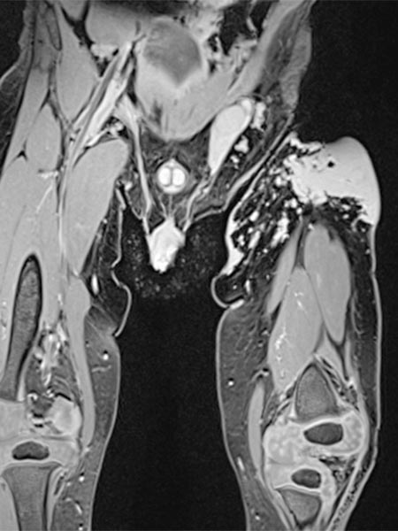 MRI: tumor in the left groin