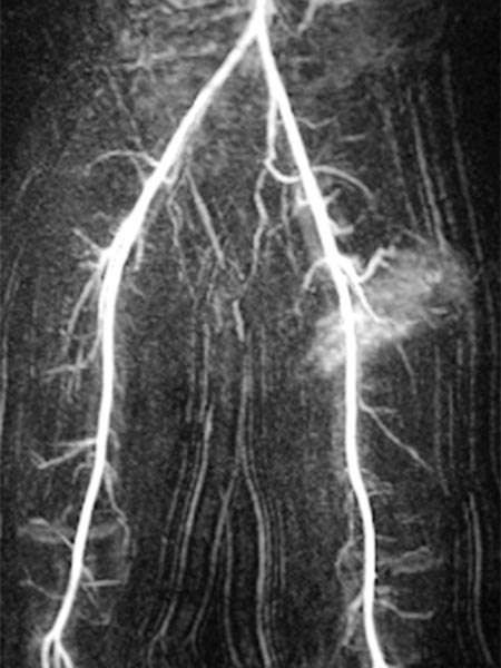 MR angiography after contrast injection