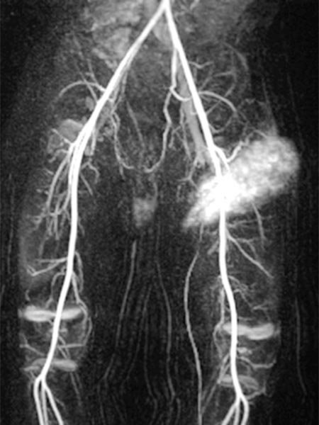 MR angiography after contrast injection