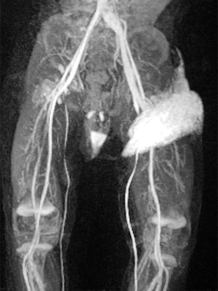 MR angiography after contrast injection