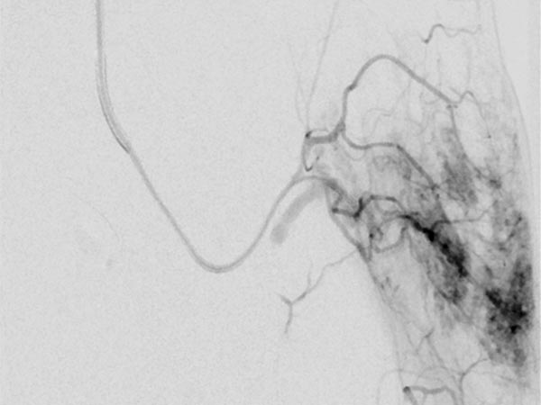 DSA: tumor is heavily perfused