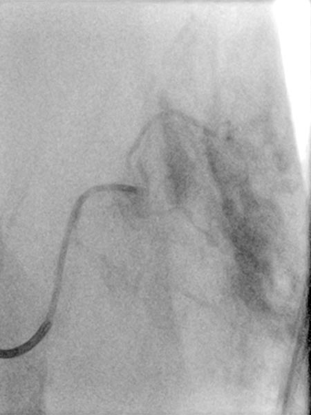 [Translate to English:] Embolization: contrast medium remain in the tumor vessels