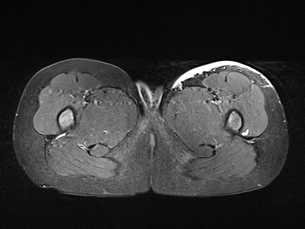 MRI: NICH is still visible under the skin