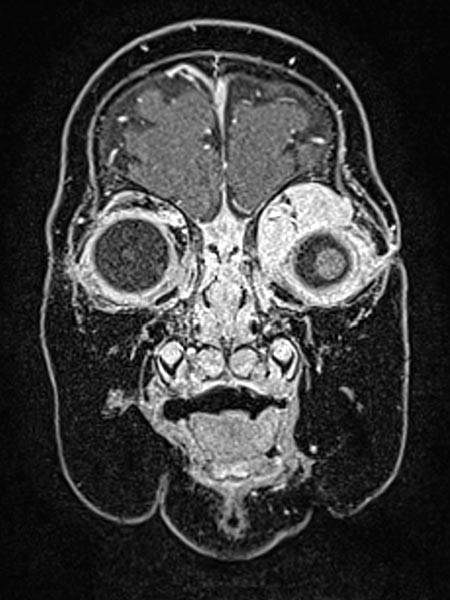 MRI: infantile hemangioma on the eyelid