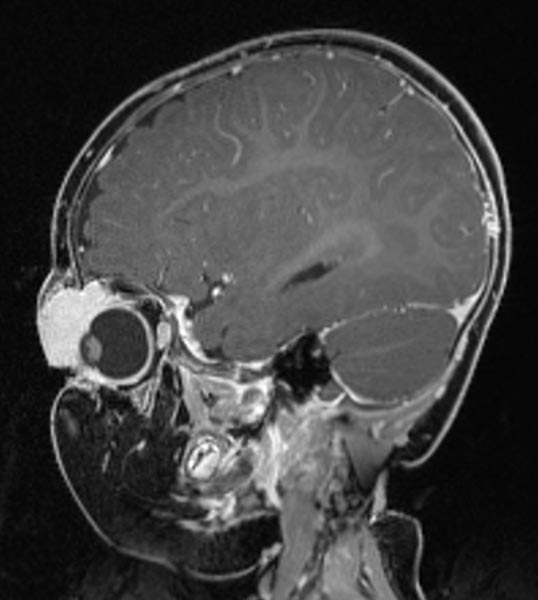 MRI: infantile hemangioma on the eyelid