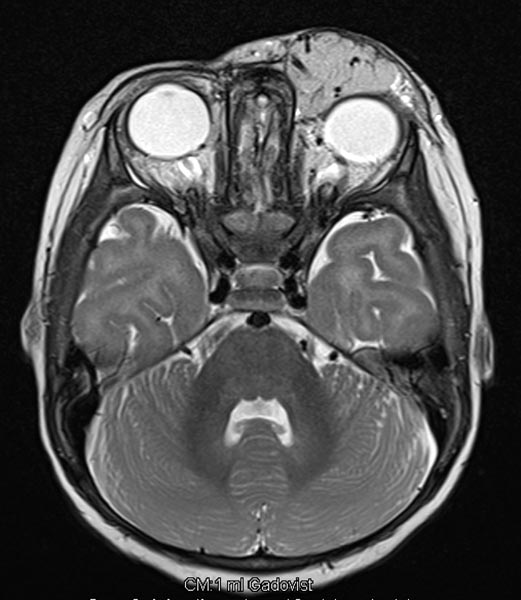 MRI: infantile hemangioma on the eyelid