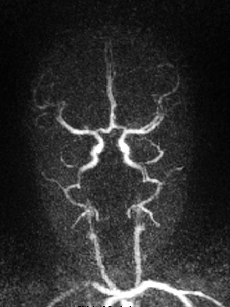 MR angiography: infantile hemangioma on the eyelid